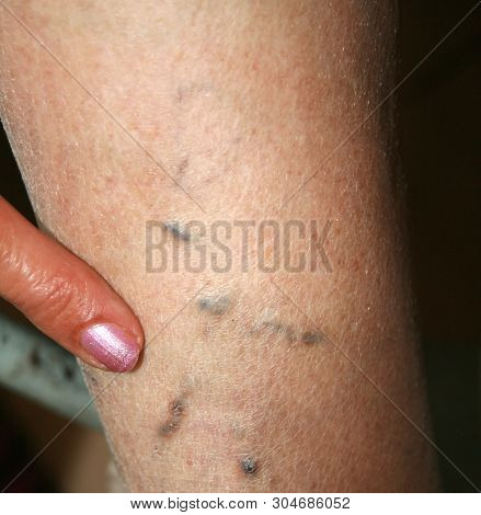 Leg. Varicose Veins. Phlebeurysm. Thrombophlebitis. Leg In Veins