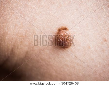 Unrecognizable Person Having Dark Fibroma, Dermatology Problem On Skin. Close Up Of Papilloma Dermat