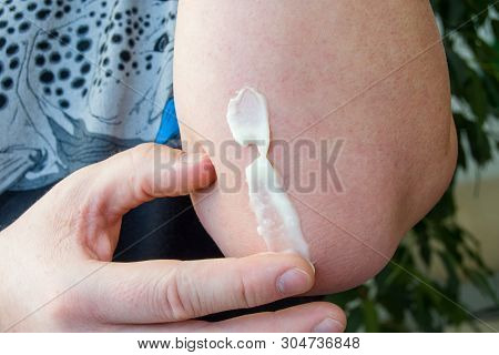 Concept Photo Of Treatment Of Skin Diseases Using Ointments As Dosage Form Of Drug. Patient Causes M