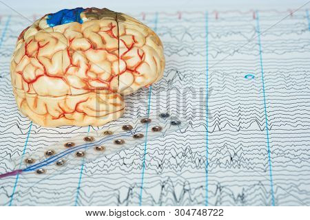 Human Brain Model And Subdural Electrode Recording Brain Waveson Background Of Brain Waves From Elec