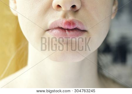 Herpes On The Upper Lip Of A Young Woman. Medical Background Of A Young Beautiful Girl With Herpes L