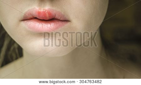 Herpes On The Upper Lip Of A Young Woman. Medical Background Of A Young Beautiful Girl With Herpes L