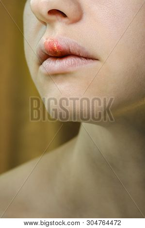 Herpes On The Upper Lip Of A Young Woman. Medical Background Of A Young Beautiful Girl With Herpes L