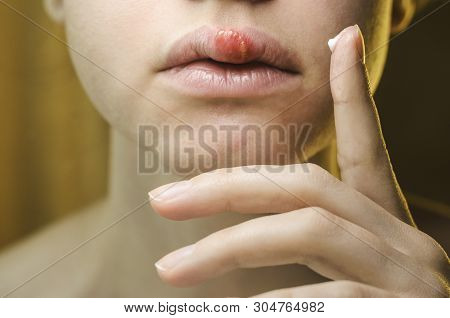 Woman Applying Ointment On Her Upper Lip With Herpes. Medical Background Of A Young Beautiful Woman 