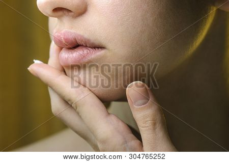 Woman Applying Ointment On Her Upper Lip With Herpes. Medical Background Of A Young Beautiful Woman 
