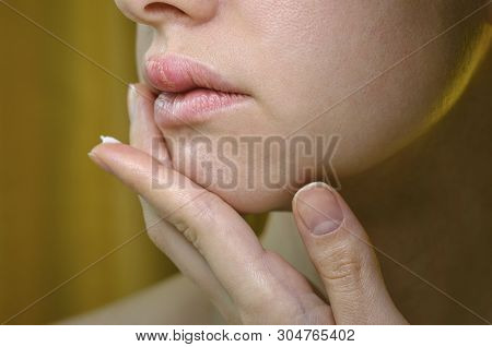 Woman Applying Ointment On Her Upper Lip With Herpes. Medical Background Of A Young Beautiful Woman 