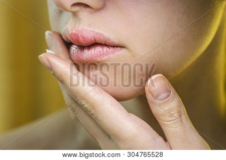 Woman Applying Ointment On Her Upper Lip With Herpes. Medical Background Of A Young Beautiful Woman 