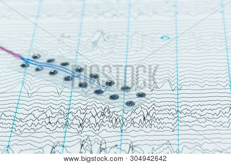 Concept Of Brain Wave Recording. Subdural Electrode On Background Of Brain Waves From Electroencepha