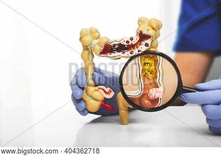 Colon Model With Different Diseases In Doctors Hands. Colon Tumor Enlarged In A Magnifying Glass