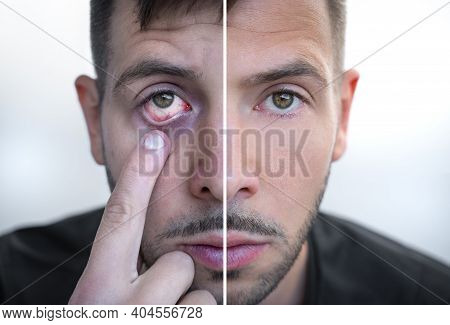Man Face Divided Into Two Parts One Healthy And One Unhealthy. Before And After Addiction Treatment.