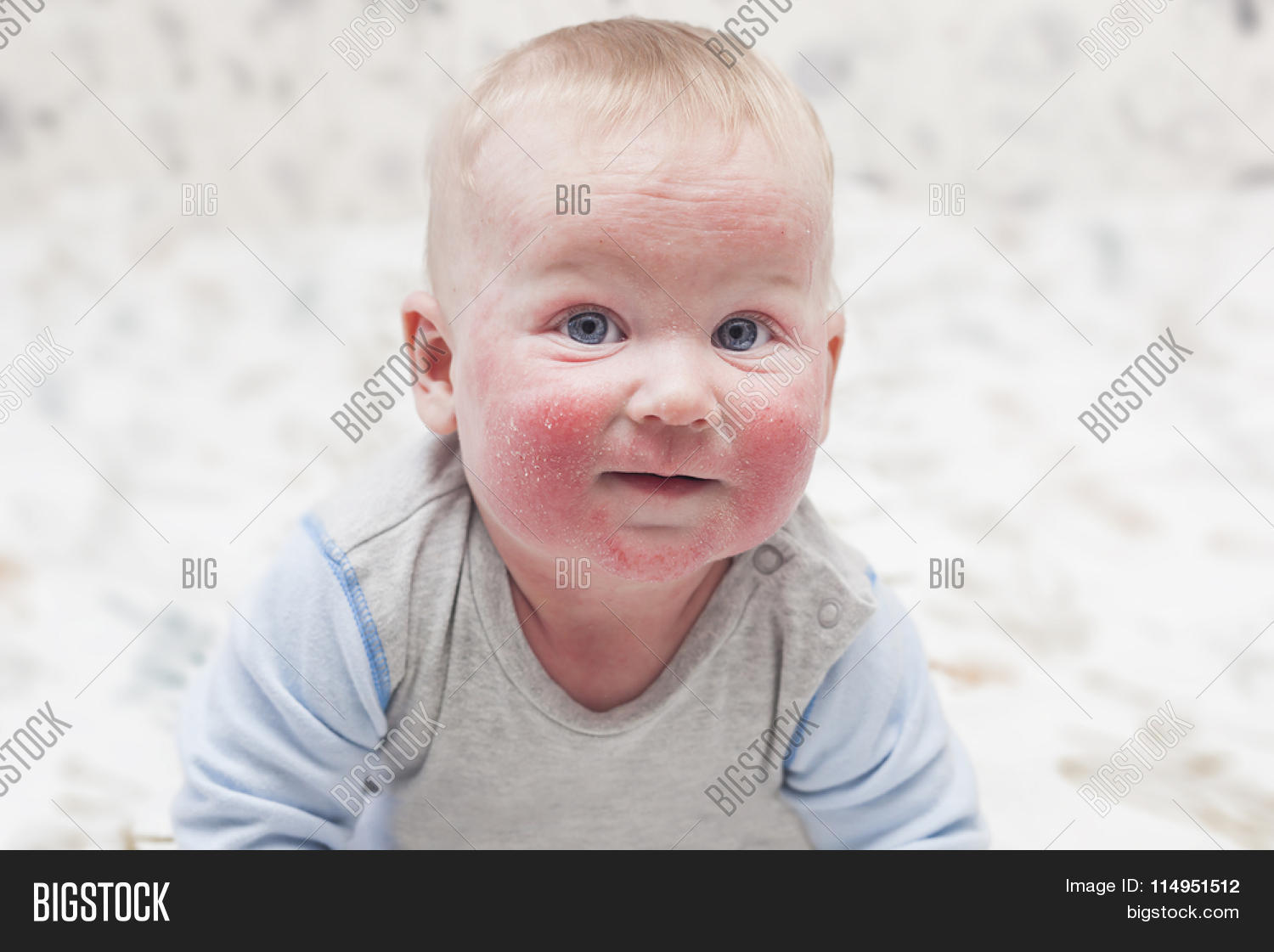 Little Baby Dermatitis Image & Photo (Free Trial) | Bigstock