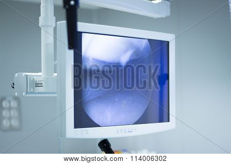 Hospital Surgery Arthroscopy Operation Screen