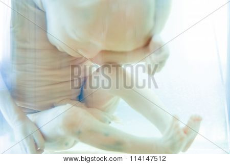Fetus in formalin solution