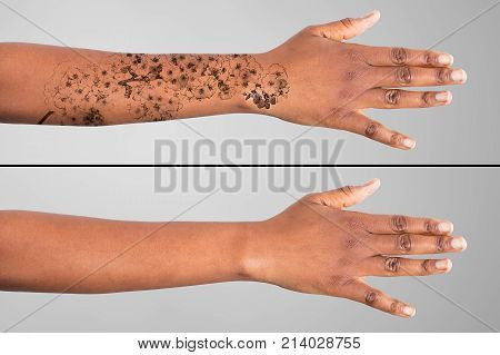 Laser Tattoo Removal On Woman's Hand Against Grey Background