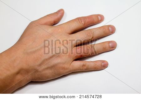 Hand dermatitis. Hand eczema closed on white background