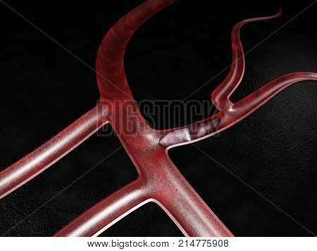 3D Illustration Of Pulmonary Thromboembolism. Thrombosis Of The Vessel
