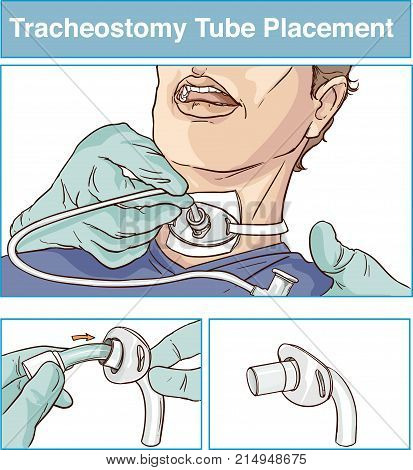 vector illustration of a tracheostomy tube placement