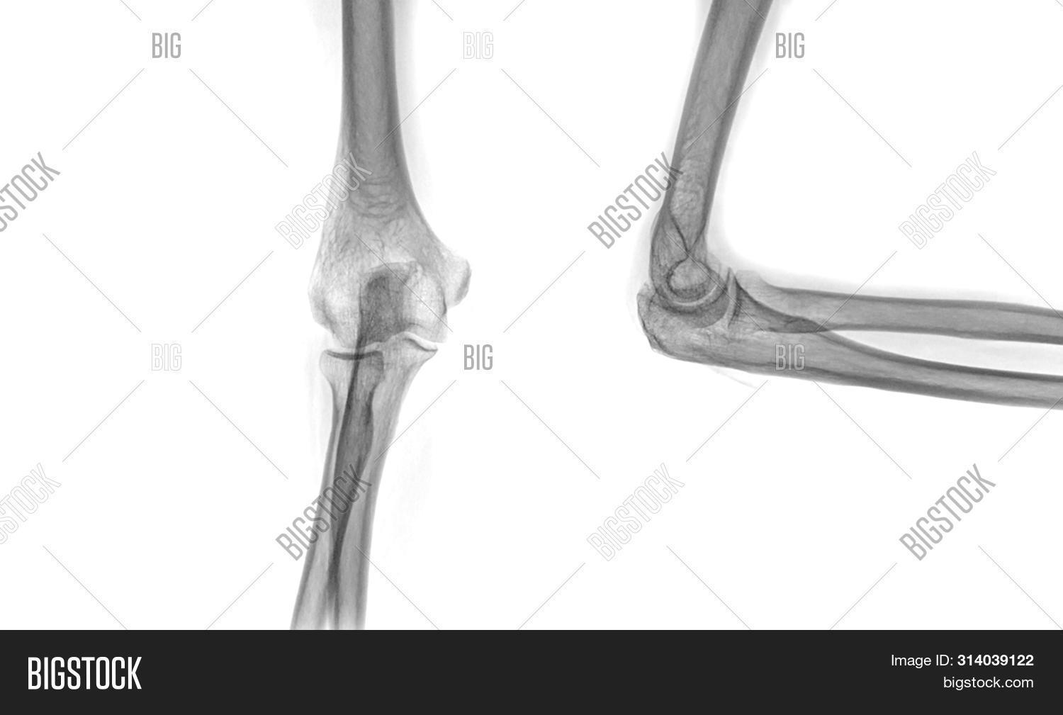 Xray Elbow Image & Photo (Free Trial) Bigstock