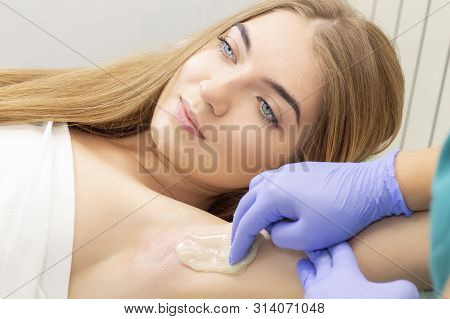 Sugaring: Epilation With Liquate Sugar At Armpit. Master Of Sugaring Making Hair Removal Procedure F