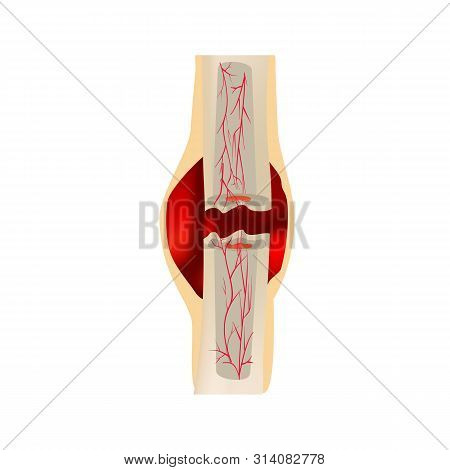 1 Stage Of Healing Bone Fracture. Formation Of Callus. Hematoma. The Bone Fracture. Infographics. Il
