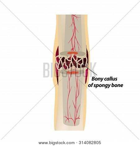 3 Stage Of Healing Bone Fracture. Callus Ossification. The Bone Fracture. Infographics. Illustration