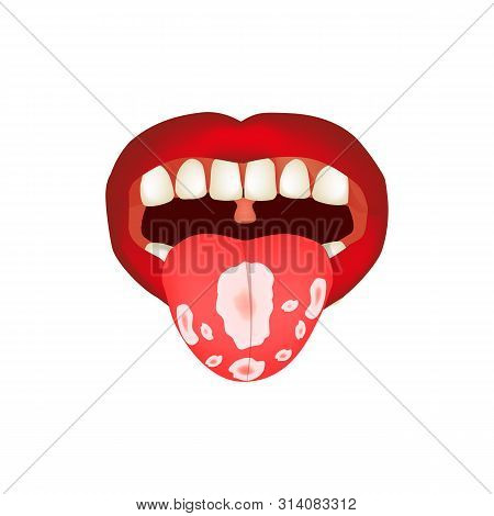 Oral Thrush. Candidiasis On The Tongue. Fungus In The Mouth. Infographics. Illustration On Isolated 