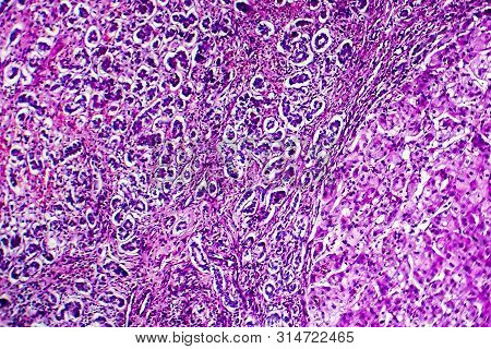 Histopathology Of Biliary Liver Cirrhosis, Light Micrograph, Photo Under Microscope