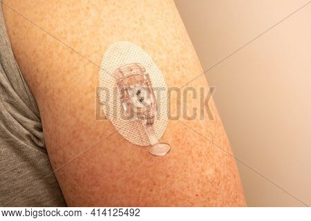 Cgm - Continuous Glucose Monitoring:  Sensor Installation On The Upper Arm. Sensor Pod And Transmitt