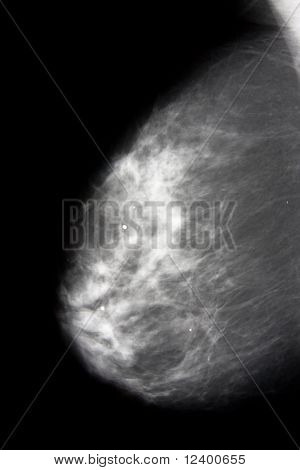 mammografia x-ray kuva