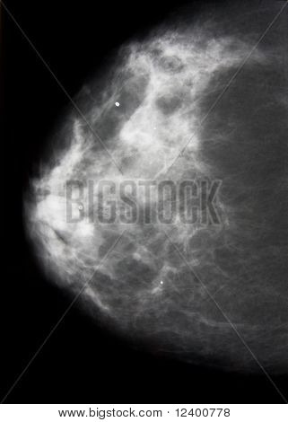 mammografia x-ray kuva