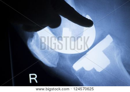 Knee Injury Metal Implant Xray Scan