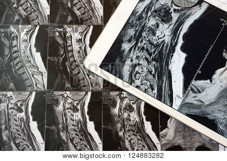 MRI Pictures of spinal column , Doctor pointing to the problem