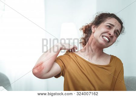 Woman Scratching Her Body While Having Allergy To Chemicals
