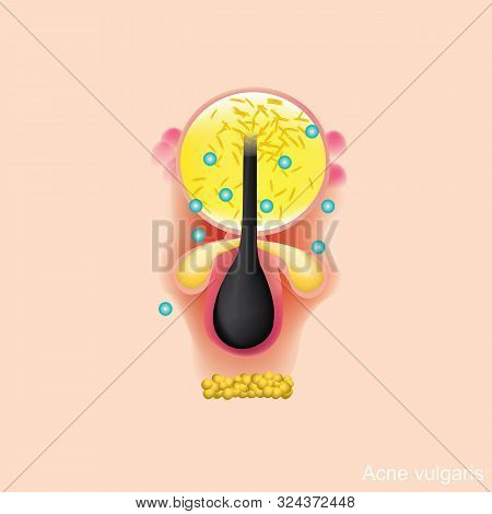 Acne Vulgarise Is A Long-term Skin Disease That Occurs When Hair Follicles Become Clogged With Dead 