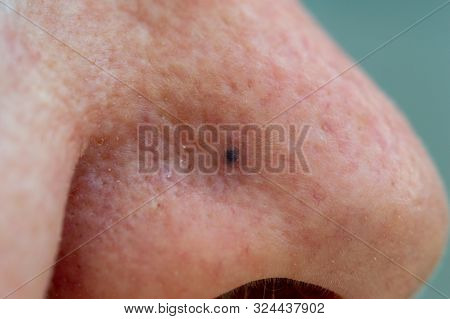 Blue Nevus On An Elderly Ladys Nose. Close Up Of The Small Dark Dot. Some Malignant Melanomas Can Lo
