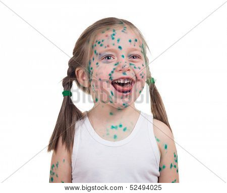 acne on child. chickenpox