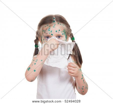 acne on child. chickenpox