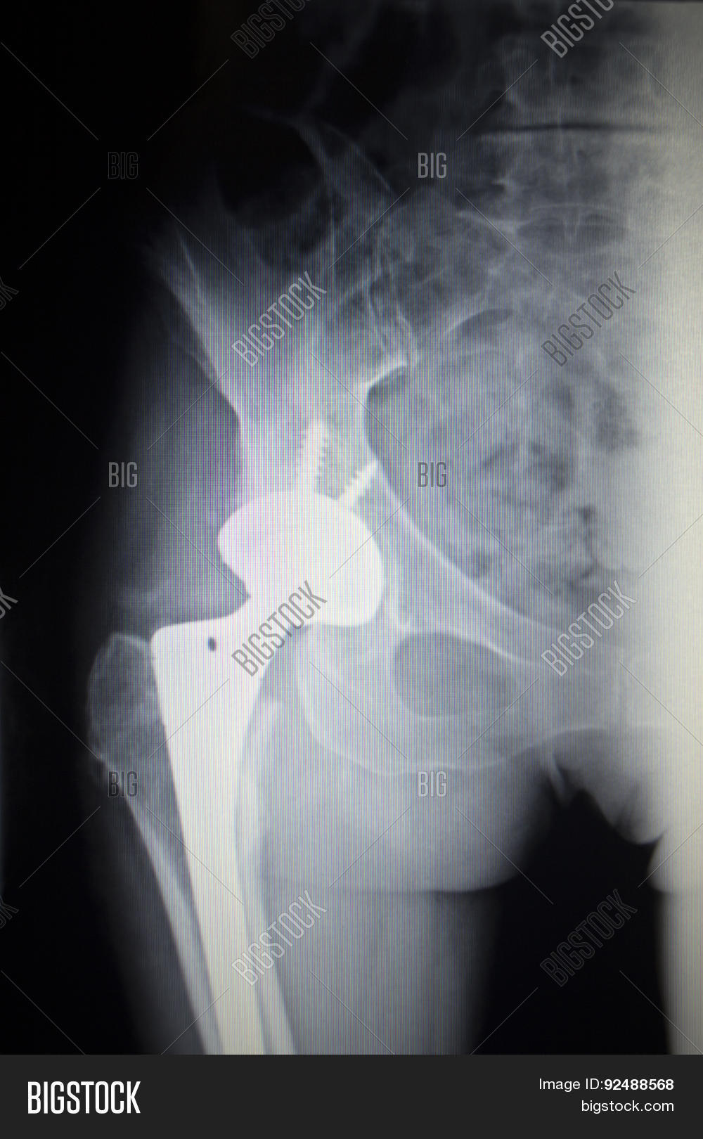 Xray Scan Image Hip Image & Photo (Free Trial) Bigstock