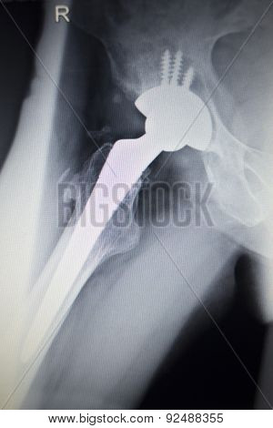 X-ray Scan  Image Of Hip Joint Replacement Orthopedic Implant