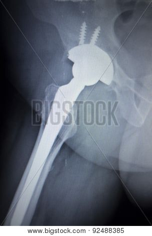 X-ray Scan  Image Of Hip Joint Replacement Orthopedic Implant