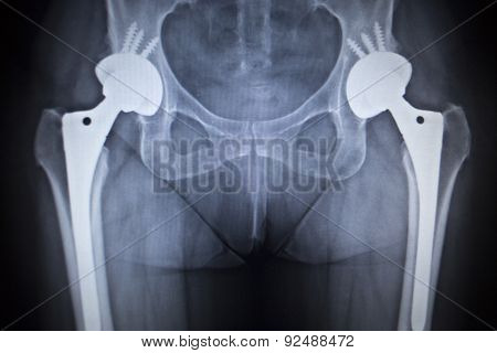 X-ray Scan  Image Of Hip Joint Replacement Orthopedic Implant