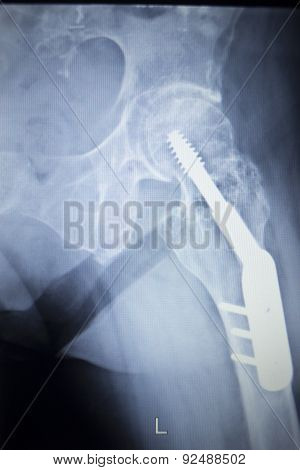 X-ray Scan  Image Of Hip Joint Replacement Orthopedic Implant