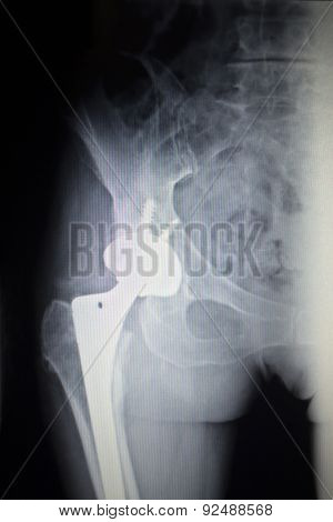 X-ray Scan  Image Of Hip Joint Replacement Orthopedic Implant