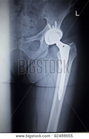X-ray Scan  Image Of Hip Joint Replacement Orthopedic Implant