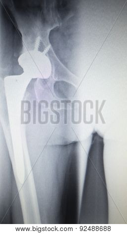 X-ray Scan  Image Of Hip Joint Replacement Orthopedic Implant