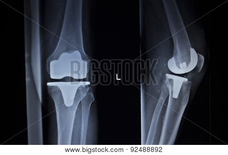X-ray Orthopedics Scan Of Knee Meniscus Implant Prosthetics