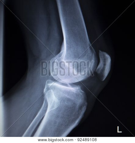 X-ray Orthopedics Scan Of Painful Knee Meniscus Leg Injury