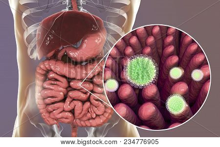 Rotaviruses In Small Intestine, 3d Illustration. Rotaviruses Are Rna Viruses The Causative Agent Of 