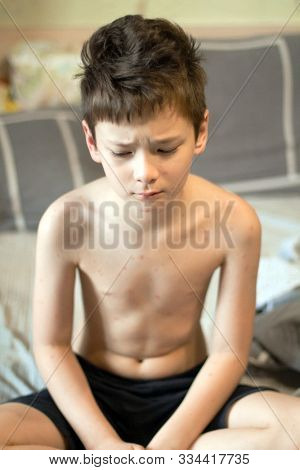 Poor boy with chickenpox. Sad little boy itching the body. Chickenpox rash