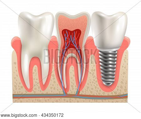 Dental Implant And Real Tooth Anatomy Closeup Cut Away Section Model Side View Realistic Vector Illu